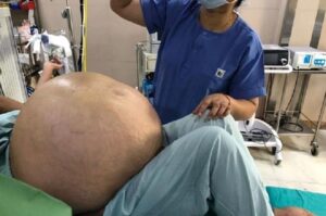 Seperti Hamil Remaja 15 Tahun, Perut Wanita Ini Membesar Begitu Cepat, Setelah Dibedah Dokter Kaget Ada Benda Seberat 49 Kg