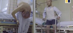 Setelah 28 Tahun Tubuh Terlipat Akhirnya Pria ini Merasakan Tubuh Berdiri Normal