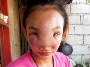 Gara-gara Pencet Jerawat di Hidung, Wajah Wanita Ini Bengkak dan Alami Kebutaan