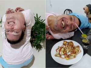 Tak Menyerah! Meski Lahir dengan Kepala Terbalik, Pria Ini Sukses Menjadi Motivator